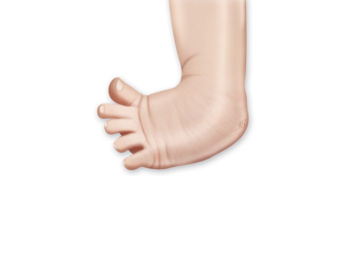 Clubfoot: Symptoms, Causes & Treatment